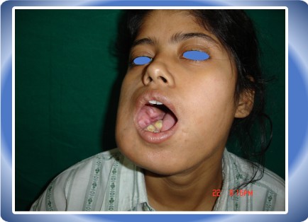 JAW TUMOUR
